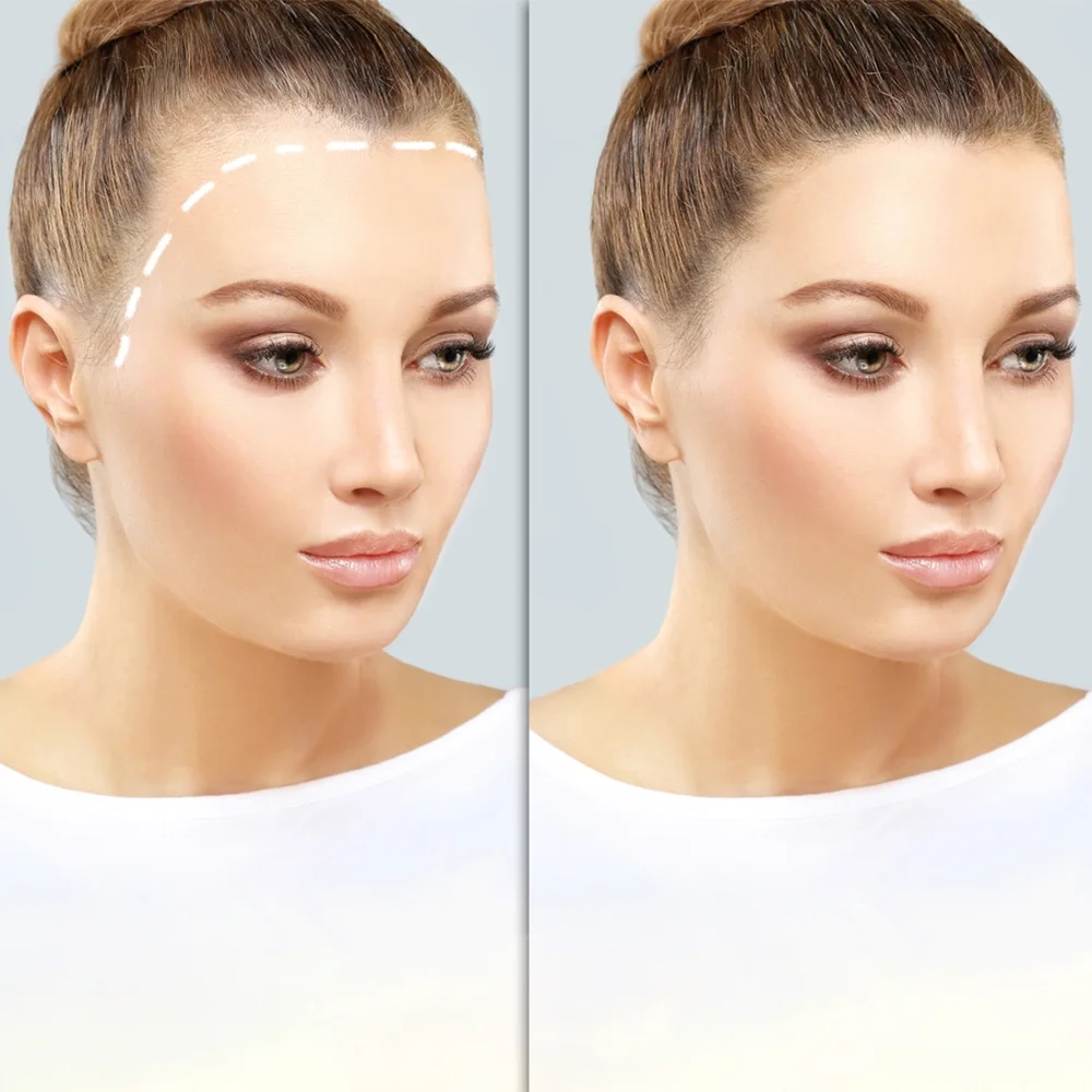Hair Transplant UK – Safe, Effective, and Long-Lasting