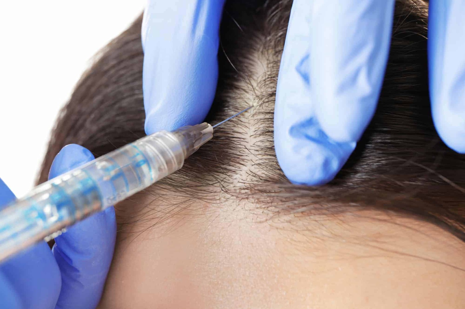 Hair Transplant Istanbul: Modern FUE and DHI Techniques Explained