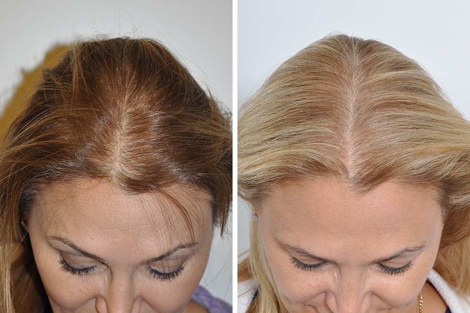 Sapphire Hair Clinic: Specialists in Hair Transplant Istanbul
