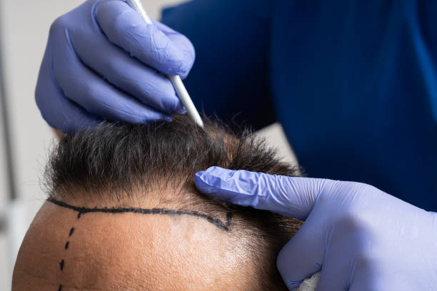 How Much Is Hair Transplant Compared to USA Prices?